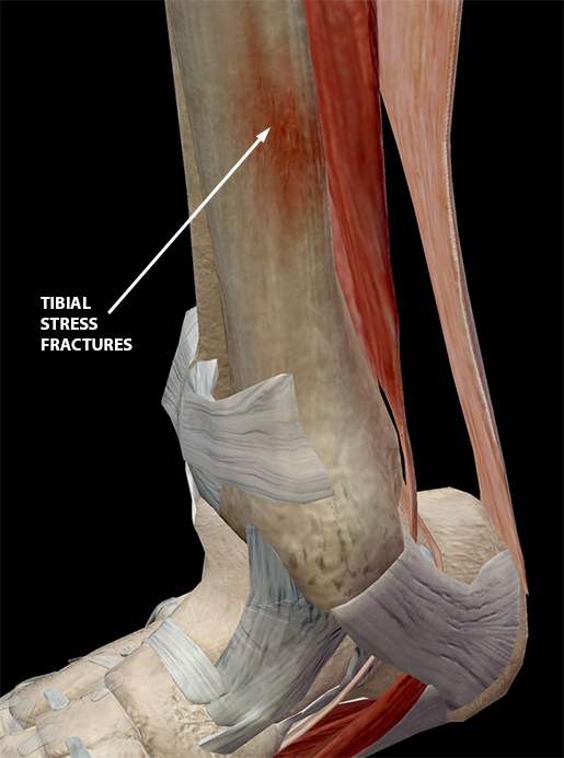 Learn Muscle Anatomy Common Sports Injuries 101